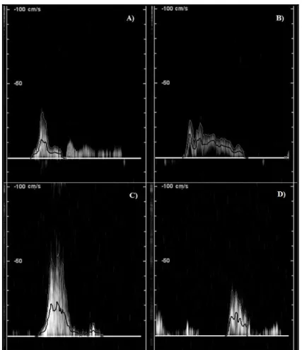 Figure 3 - Venous ultrasound assessment at popliteal vein during first and tenth calf  contraction, during tip-toe movement for both control and CVD group 