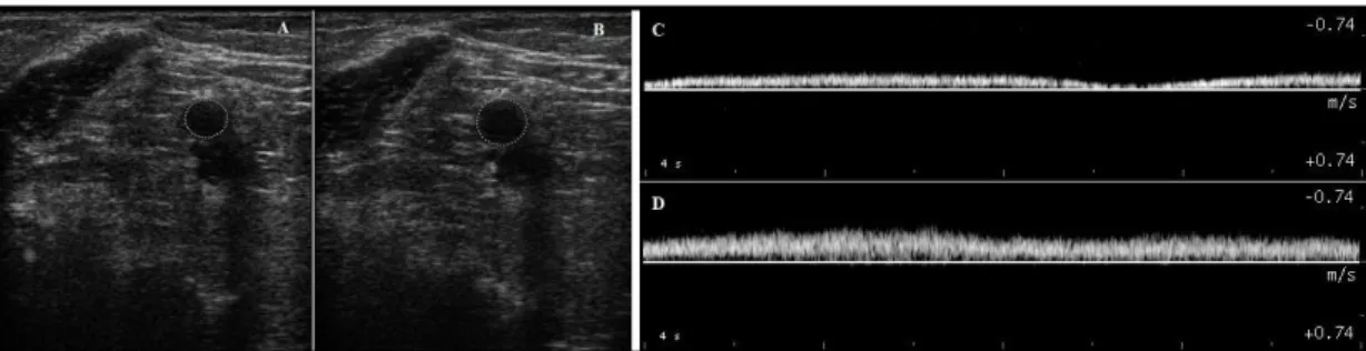 Figure 4 - Representative ultrasound images showing the effect of MLD  