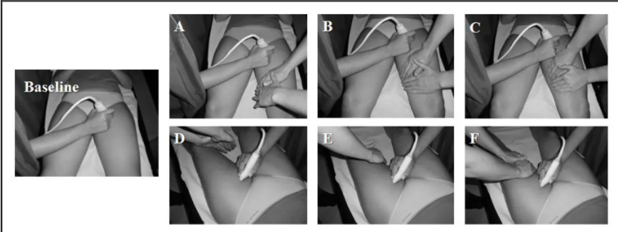 Figure 6 - Vascular ultrasound evaluation context with curtain separating  sonographer, therapist and participant, during manual lymphatic drainage maneuvers 