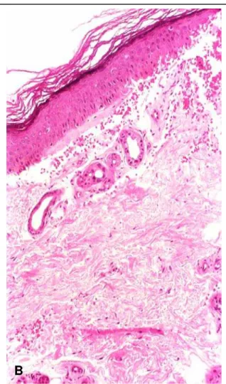 FIGURA 3.   PELE EXPOSTA AO SOL (DORSO DA MÃO) DE DOENTE TRANS- TRANS-PLANTADO RENAL (DOENTE STE)  