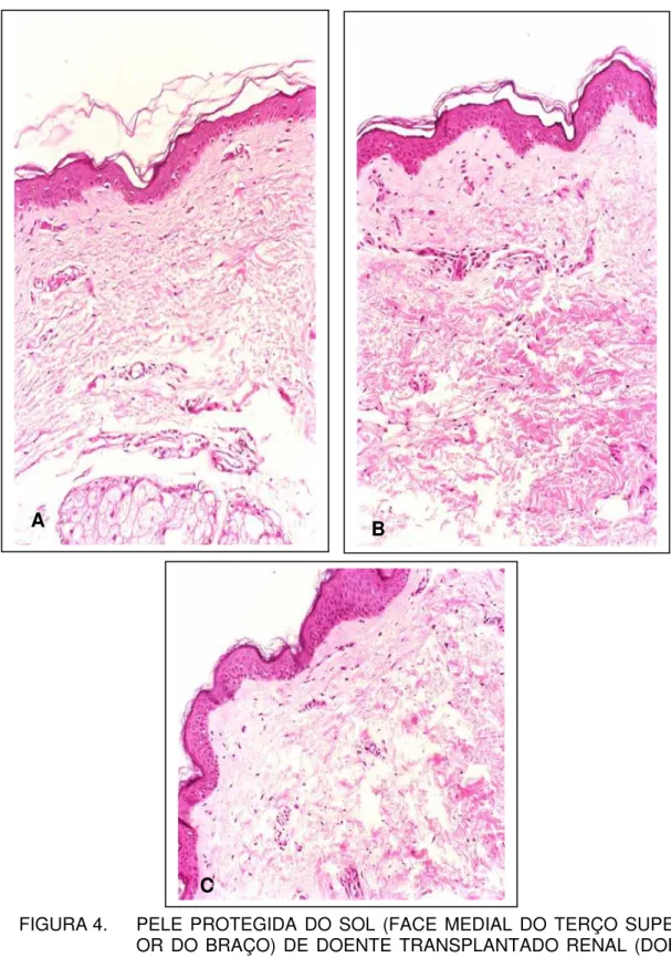 FIGURA 4.   PELE PROTEGIDA DO SOL (FACE MEDIAL DO TERÇO SUPERI- SUPERI-OR DO BRAÇO) DE DOENTE TRANSPLANTADO RENAL  (DOEN-TE S(DOEN-TE)  