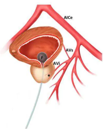 Figura 1A. Ilustração da relação dos ramos da artéria ilíaca comum esquerda (AICe) com a  próstata e bexiga usando o balão da sonda de Foley (F) preenchido com contraste iodado