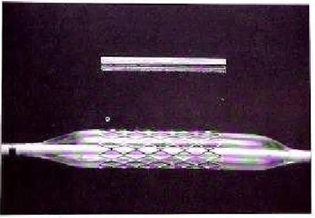 Figura 3 – Endoprótese vascular tipo Palmaz  . 