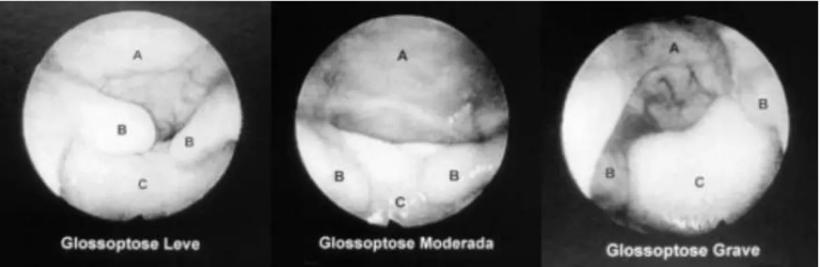 Figura 10 - Gravidade  da  glossoptose  classificada  através  da  vídeo-faringo-laringoscopia  com  endoscópio  flexível
