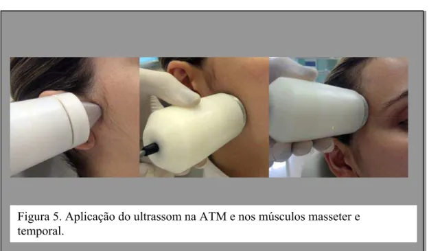 Figura 5. Aplicação do ultrassom na ATM e nos músculos masseter e  temporal. 