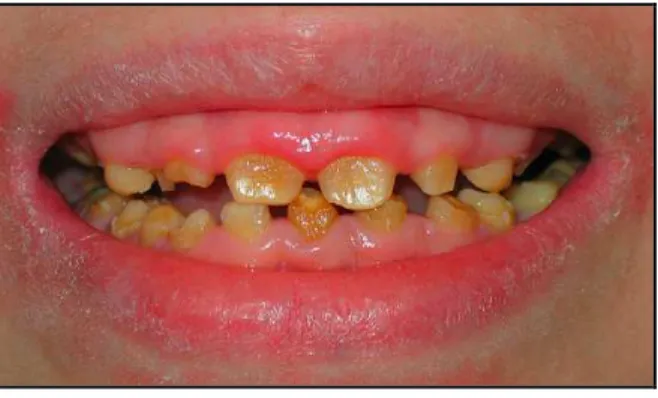 Figura 4. Anomalia de desenvolvimento dentário em paciente com epidermólise  bolhosa juncional