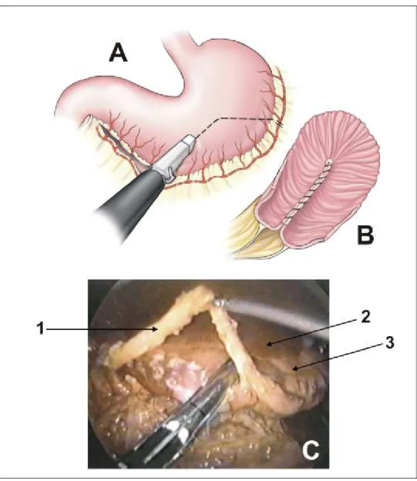Figura 2 -  (A): Após dissecção cuidadosa do pedículo da artéria gastroepiplóica  direita, com uso de eletrocautério ou clipes, obtém-se segmento em cunha  da grande curvatura do estômago, de cerca de 10cm  x 4cm, com  grampeador laparoscópico
