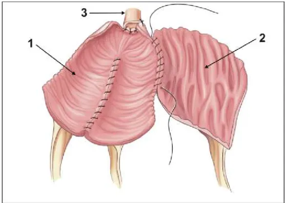 Figura 3 -  Confecção laparoscópica do segmento gastroileal composto, com sutura  contínua de fio absorvível entre a placa de íleo em “U” invertido e acunha  gástrica