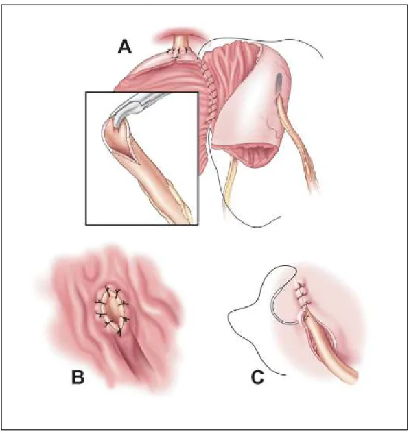 Figura 5 -  (A):  Anastomose entre íleo e uretra, com segmento gastroileal composto  destubularizado