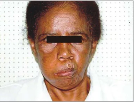 Figura 6 -  Foto  de  paciente  inflando  a  bochecha  do  lado  da  paralisia  (lado  direito  da  face)