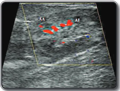 Figura 5 - Mapeamento Doppler colorido de rim normal de gato evidenciando a vascula- vascula-rização intrarrenal artérias interlobares (AI) e artéria arqueada (AA).