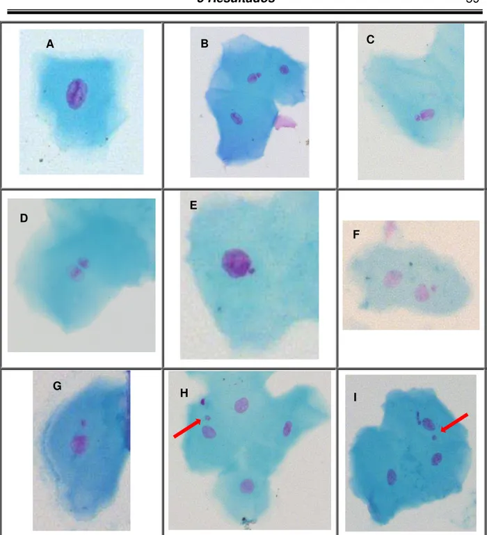 Figura  2  –   Fotomicrografias  de  células  esfoliadas  da  mucosa  bucal:  A  –   célula  com  cromatina  condensada; B, C, D  –  broto nuclear; E, F, G, H, I  –  micronúcleo; A, B, C, E, F, G, H, I  –  aumento de  400X; D  –  aumento de 1000X F B  C D 