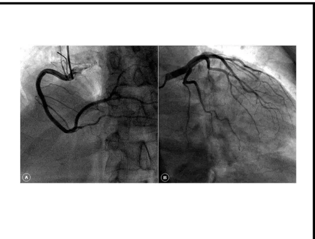 Figura 1: Imagens do filme da cinecoronariografia de um voluntário do estudo  demonstrando artérias coronárias epicárdicas livres de lesões obstrutivas; A – Coronária  Direita e B – Coronária Esquerda