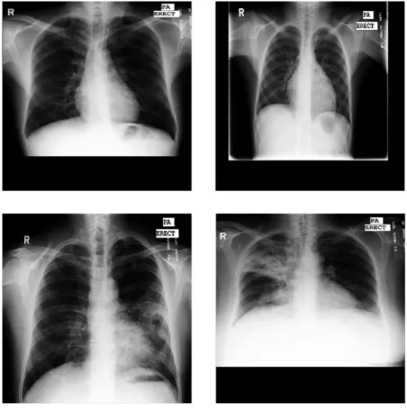 Figura 6: Exemplos de radiograﬁas na base Montgomery. As radiograﬁas no canto superior direito e esquerdo exibem, respectivamente, pulmões saudáveis de um homem de 33 anos e de um garoto de 8.