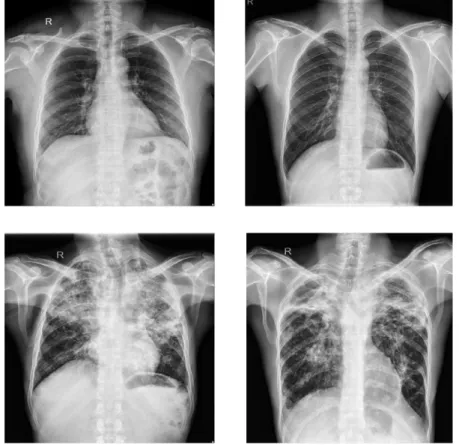 Figura 7: Exemplos de radiograﬁas da base Shenzen. As radiograﬁas na metade superior são casos de pulmões saudáveis: a radiograﬁa a esquerda é de uma mulher de 48 anos e a radiograﬁa a direita pertence a um homem com 24 anos de idade