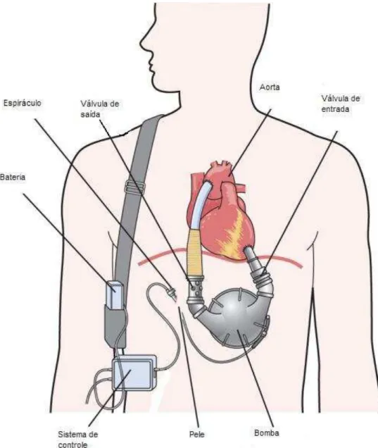 Figura  3  -  DAV  implantado  no  coração  natural.  (MD  Consult:  Ventricular  assist  device: 