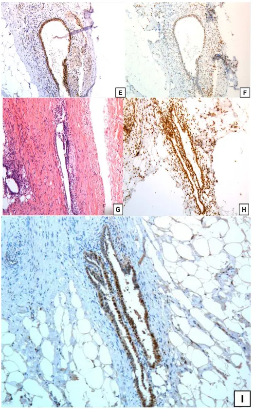 Figura  2.1  -  E-F:Biópsia  de  peritôneo  de  parede  pélvica  -  Estádio  I  ou  II  de  endometriose;  (H-E;  8OHdG;  OGG1)  respectivamente