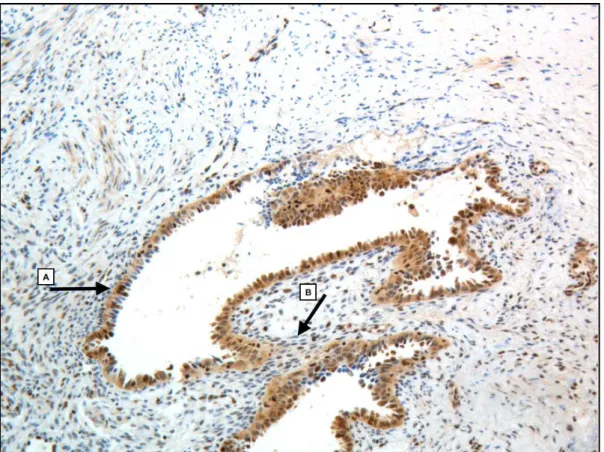 Figura  5:Avaliação  por  imunohistoquímica  do  OGG1  (aumento  de  10x)  no  tecido  com endometriose profunda de bexiga marcada para 8 OhdG.Seta [A] aponta para o  alto  grau  de  reparo  de  DNA  na  glândula  do  tecido  com  endometriose.Seta[B] 