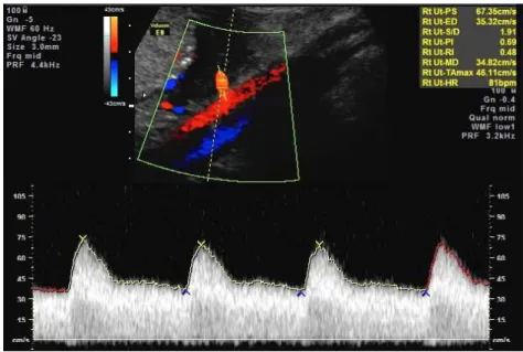 Figura 12 - Sonograma da artéria uterina direita 