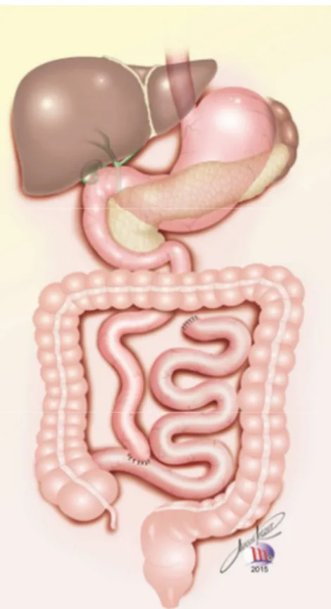 Figura 1 - Bypass intestinal em “T” de Payne 