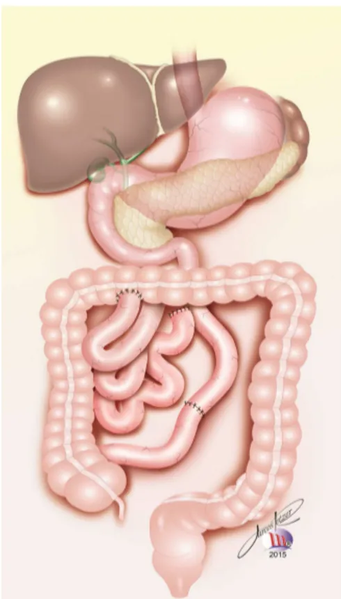 Figura 2 - Bypass intestinal de Scott 