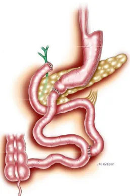 Figura 12 – Derivação biliopancreática “Duodenal Switch” 