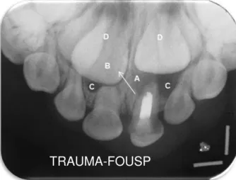 Figura 4.2  –  Parâmetros radiográficos adotados no diagnóstico de cisto radicular em dente decíduo  traumatizado:  dente  61