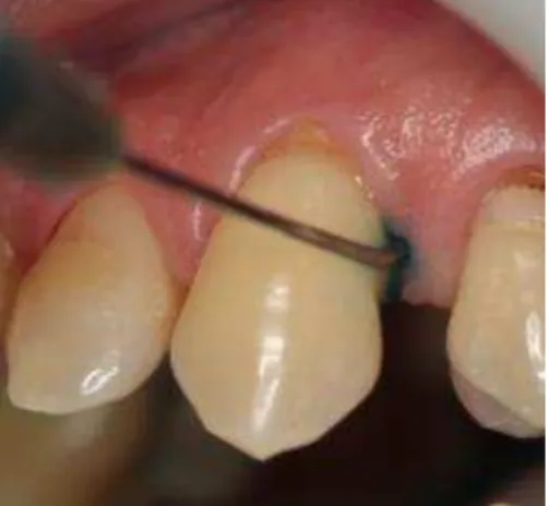 Figura 4.4 - O fotossensibilizador é dispensado na bolsa periodontal  