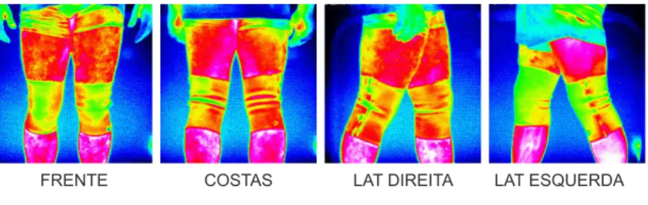 Figura 20 - termografia dos joelhos com órtese após vinte  minutos de caminhada.