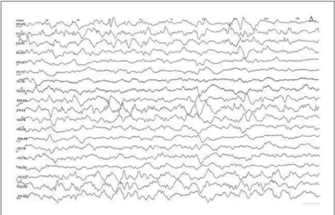 Fig 2. After treatment, sleep EEG with re- re-mission of the burst-suppression pattern