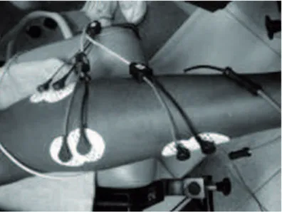 FIGURA 1 - Posicionamento dos eletrodos nos músculos do TS da perna direita, segundo recomendação do SENIAM 18 .