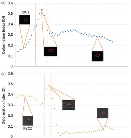 Figure 12 shows the DI along the microchannel for RBCs 1 and 2. We can observe that RBC 1 had a higher value when the cell was passing in the microstenosis region