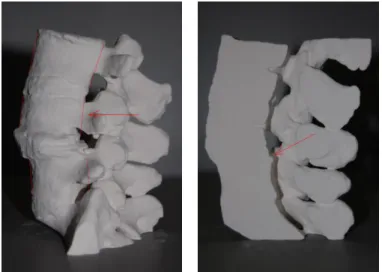 Figure  7.  Problem  areas  highlighted  in  the  printed  models  -  vertebra misalignment and spinal canal estrangement