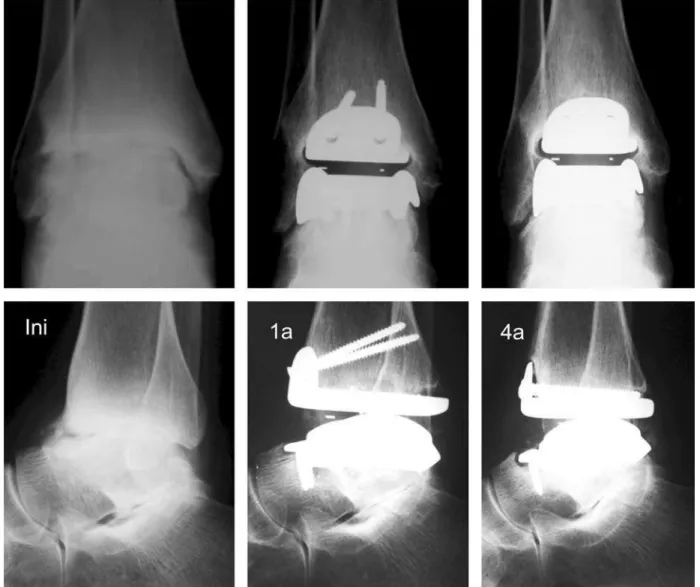 Figura 3 – Paciente #5: Radiografias em AP e perfil do tornozelo D em três diferentes momentos – inicial, um ano de PO e quatro anos  de PO