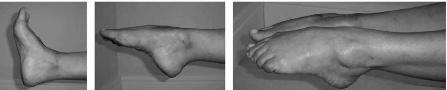 Figura 6 – Paciente #4 – Arco de movimento do tornozelo direito, vítima de artrose pós-infecciosa, comparável ao do lado normal  na última avaliação, ao final de quatro anos de PO