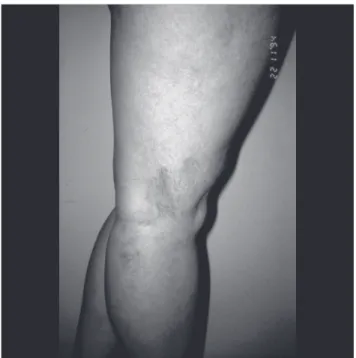 Table 2 – Prevalence of varicose disease in the 352 patients studiedFigure 3 - Telangiectasias (CEAP C1)