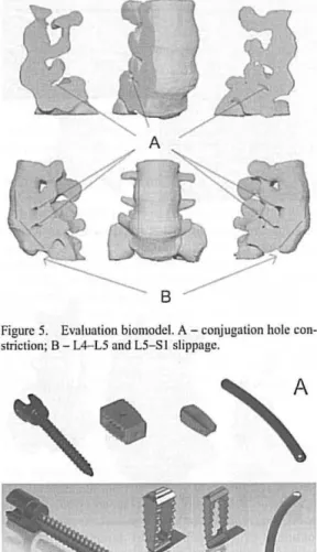 Figure  6.  Multiaxial  pediclc scrcw,  PEEK cagcs and lon- lon-gitudinal  rod:  A  - real  devices;  B  - 3D  modclcd  dcvices