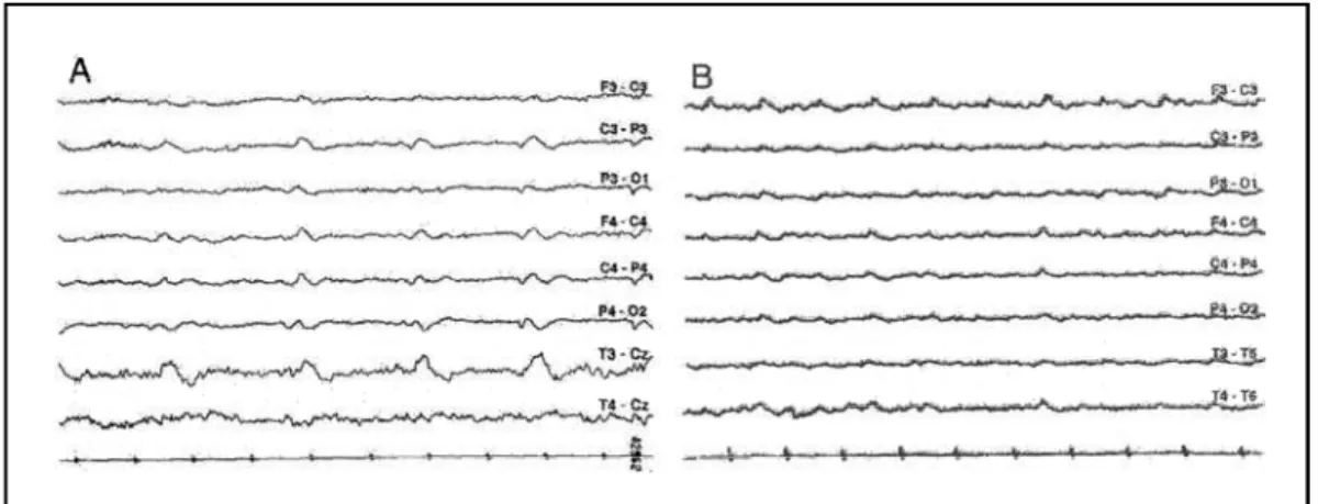 Fig 1. A) Case 1. EEG showing short generalized periodic activity (slow sharp waves). B) Case 2