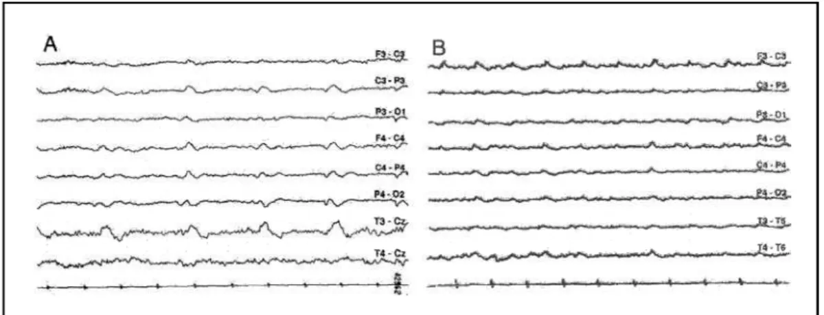 Fig 1. A) Case 1. EEG showing short generalized periodic activity (slow sharp waves). B) Case 2
