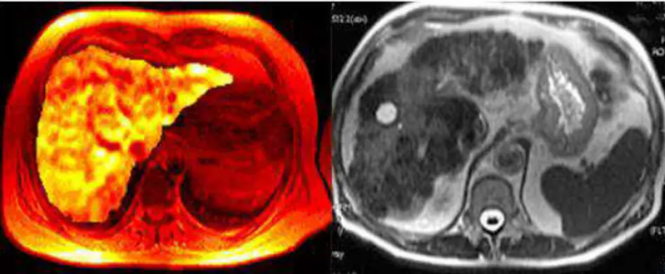 Figura 5: Imagem de um fígado obtido por ressonância magnética; esquerda: obtida por ressonância  magnética sem agente de contraste; direita: obtida por ressonância magnética usando um líquido de  nanopartículas de ferro como agente de contraste (Adaptado 