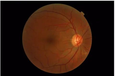 Figura 5 - Imagem Normal do Fundo Olho retirada da base de dados Messidor. 