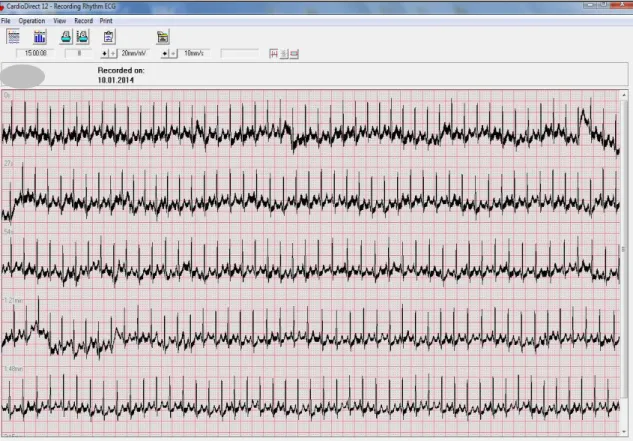 Figura 10. Exemplo da recolha de um sinal de ECG. 