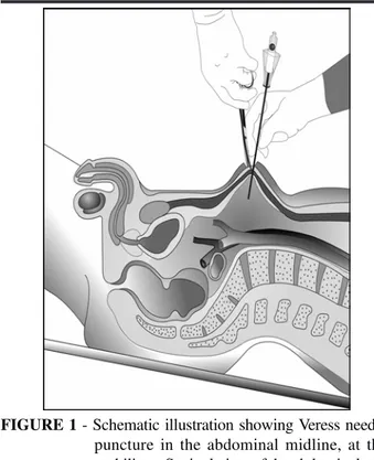 FIGURE 1 - Schematic illustration showing Veress needle puncture in the abdominal midline, at the umbilicus