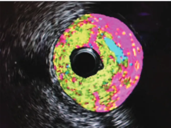 Figure 1 – Intravascular ultrasound cross-sectional image with iMAP™ 