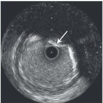 Figure 3 – Intravascular ultrasound of the right coronary artery show- show-ing compatibility with calcium nodule (dense, eruptive mass, with  irregular surface, in contact with and/or near the lumen, as indicated  by the arrow).