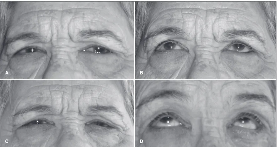 Figure 2 - Patient with involutional entropion in the left eye. A) In primary position of gaze before the application of octyl-2-cyanoacrylate liquid bandage; B) In upgaze position before the application of octyl-2-cyanoacrylate liquid bandage; C) In prima