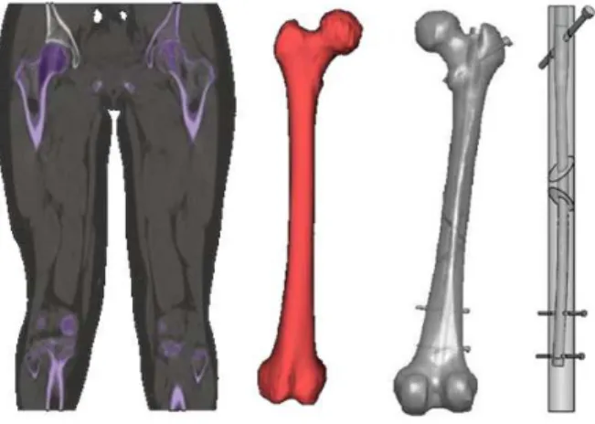 Fig. 2. Biomodelo do fémur, Biomodelo e Modelo Simplificado (osso-haste-parafusos). 