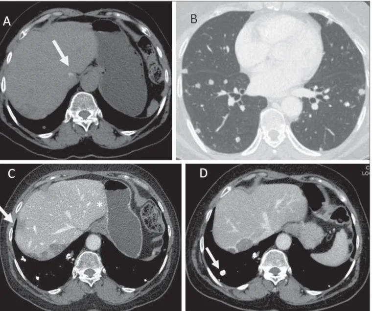 Figure 7. Epithelioid hemangioendothelioma. Non-contrast-enhanced abdominal CT identifies the presence of hypodense peripheral hepatic nodules intermingled with foci of calcifications (arrow on A), which may occur in up to 25% of cases