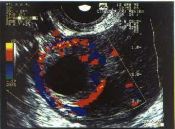 Figura 1 –  Caso de gravidez tubária apresentando fluxo trofoblástico que acomete todo o anel tubário (doppler de elevado risco).
