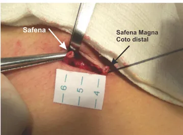 Figure 2 - Section of the great saphenous vein between ligatures distal to the tributaries.